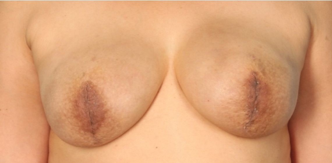 after breast reconstruction front view case 805