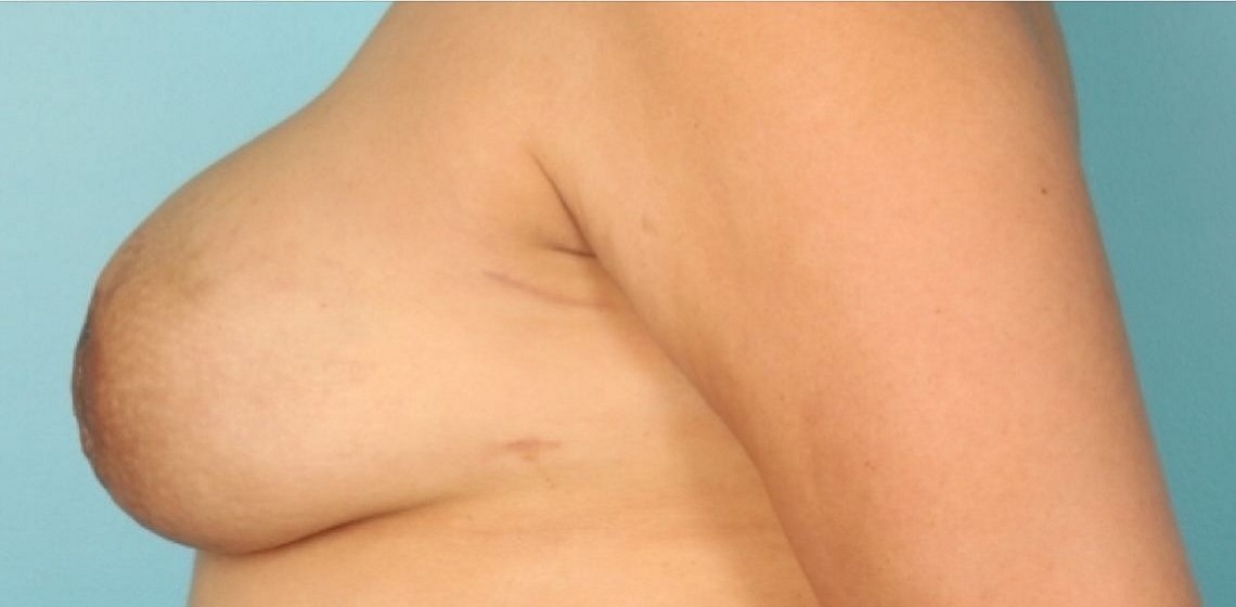 after breast reconstruction side view case 805