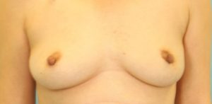 before breast reconstruction front view case 814