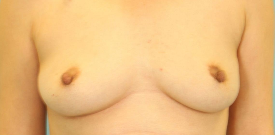 before breast reconstruction front view case 814