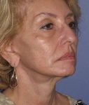 after Facelift female patient diagonal angle view Case 1567