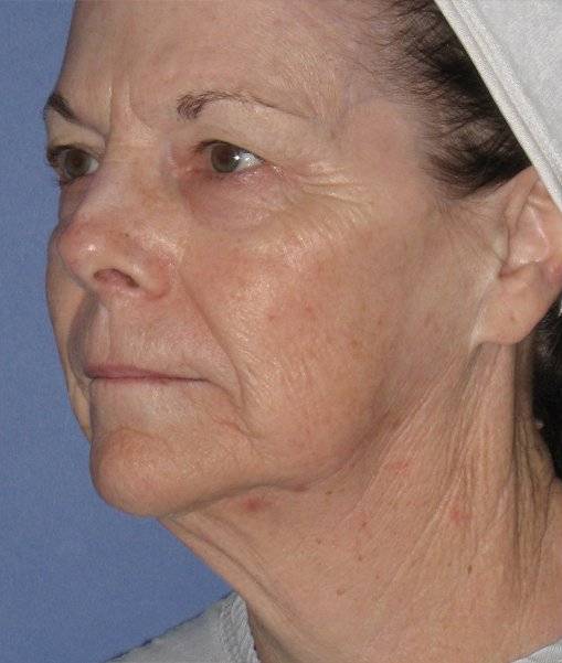before Facelift female patient diagonal angle view Case 1584