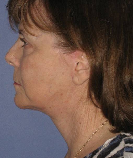 after Facelift female patient side angle view Case 1584
