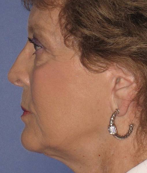 after Facelift female patient side angle view Case 1591