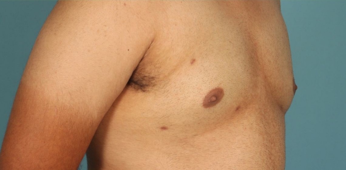 after gynecomastia right angle view of male patient 653 at Paydar Plastic Surgery
