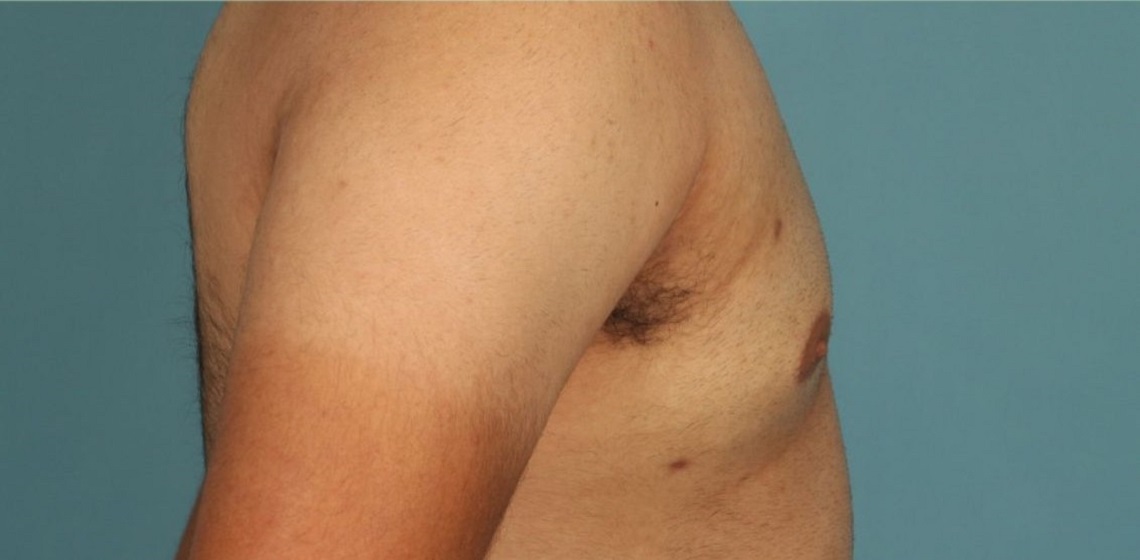 after gynecomastia right view of male patient 653 at Paydar Plastic Surgery