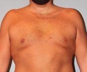 before gynecomastia front view of male patient 661 at Paydar Plastic Surgery