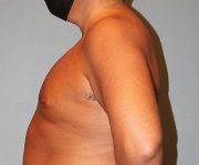 before gynecomastia left view of male patient 661 at Paydar Plastic Surgery