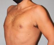after gynecomastia left angle view of male patient 661 at Paydar Plastic Surgery