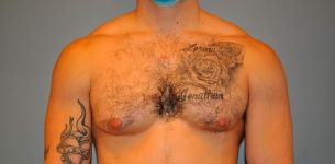 before gynecomastia front view of male patient 673 at Paydar Plastic Surgery