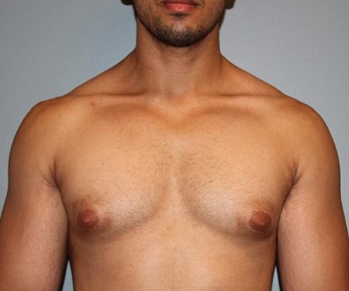 before gynecomastia front view of male patient 688 at Paydar Plastic Surgery