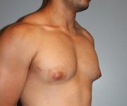 before gynecomastia right angle view of male patient 688 at Paydar Plastic Surgery