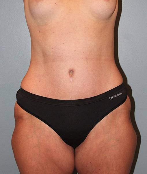after liposuction front view female case 1035