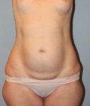 before liposuction front view female case 1035