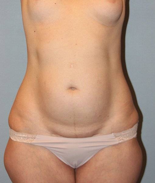 before liposuction front view female case 1035
