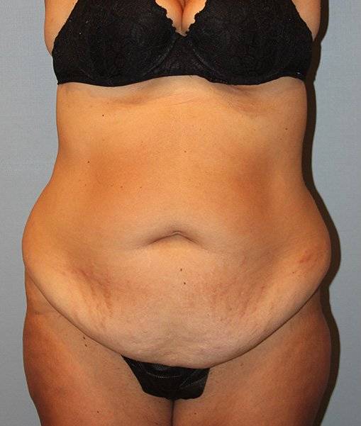 before liposuction front view male case 1042