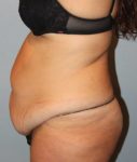 before liposuction side view female case 1042
