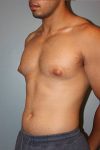 before liposuction front left angle view male case 1050