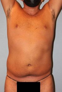 before liposuction front view male case 1064