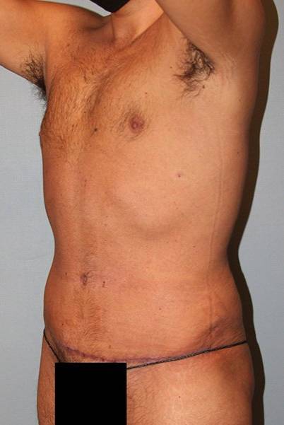 after liposuction front angle view male case 1064
