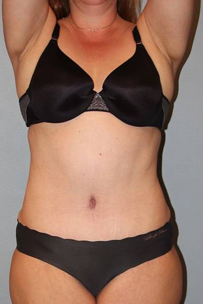 after liposuction front view female case 1110