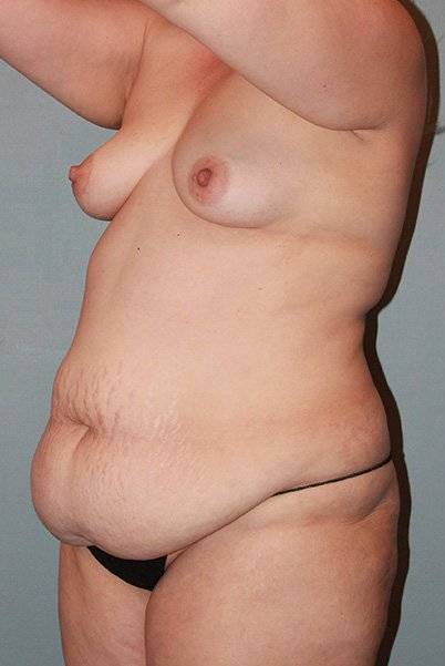 before liposuction angle view female case 1110