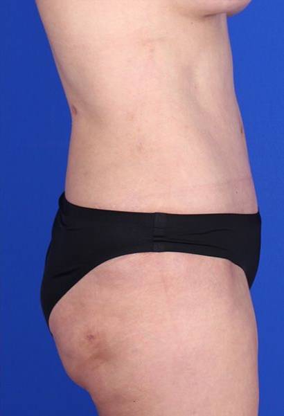 after liposuction side view female case 979