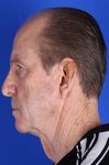 before neck lift side view male case 1151