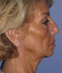 before neck lift side view female case 1165