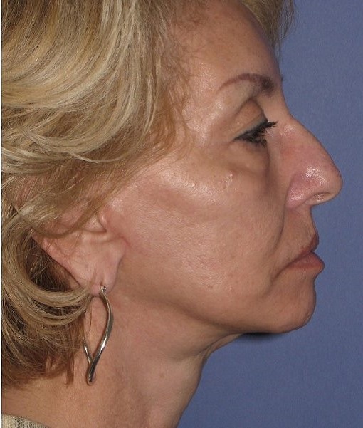 after neck lift side view female case 1165
