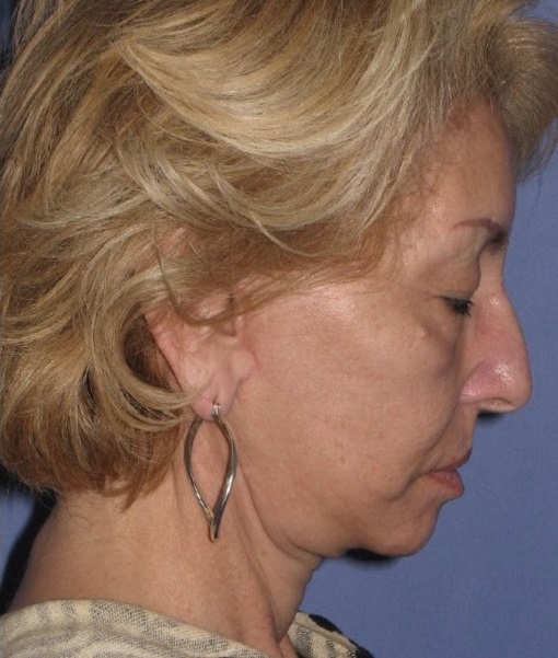 after neck lift side view female case 1165