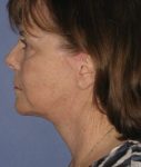 after neck lift female side view case 1180