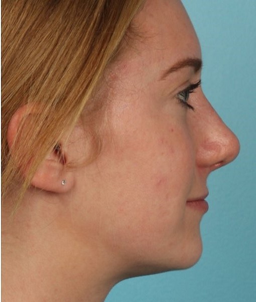 after rhinoplasty right view of female patient 608 at Paydar Plastic Surgery