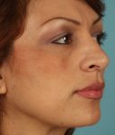 before rhinoplasty right angle view of female patient 615 at Paydar Plastic Surgery