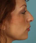 before rhinoplasty right side view of female patient 615 at Paydar Plastic Surgery