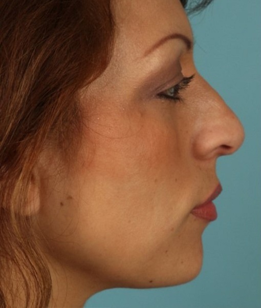 before rhinoplasty right side view of female patient 615 at Paydar Plastic Surgery