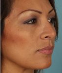 after rhinoplasty right angle view of female patient 615 at Paydar Plastic Surgery