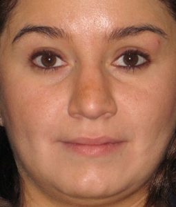 before rhinoplasty front view of female patient 622 at Paydar Plastic Surgery