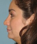before rhinoplasty left side view of female patient 622 at Paydar Plastic Surgery