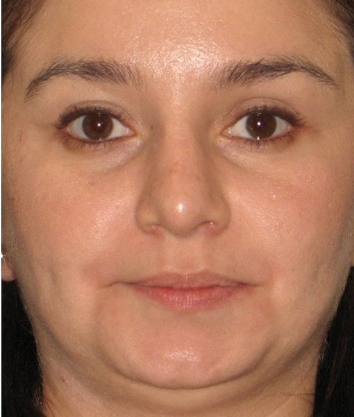 after rhinoplasty front view of female patient 622 at Paydar Plastic Surgery