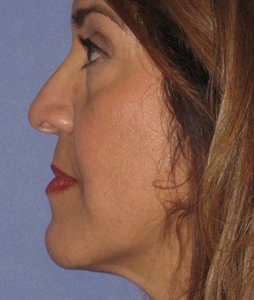 before rhinoplasty right side view of female patient 630 at Paydar Plastic Surgery