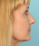 after rhinoplasty right side view of female patient 638 at Paydar Plastic Surgery