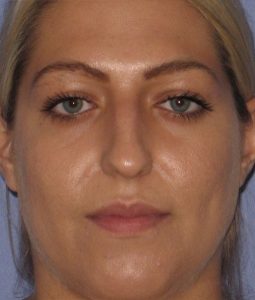 before rhinoplasty front view of female patient 646 at Paydar Plastic Surgery