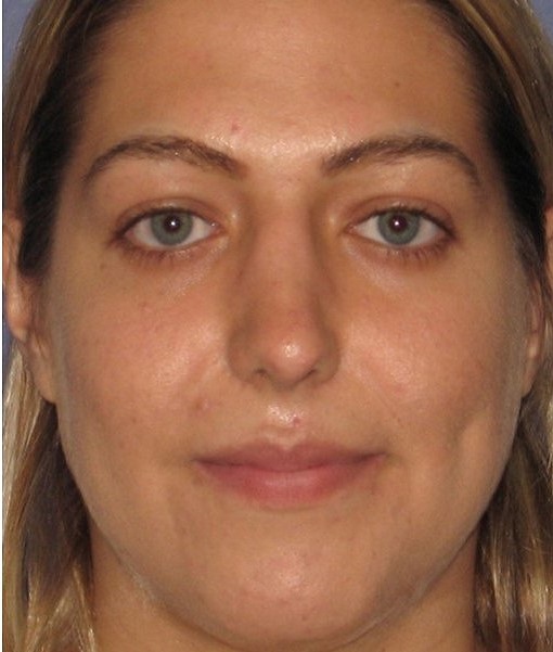 after rhinoplasty front view of female patient 646 at Paydar Plastic Surgery