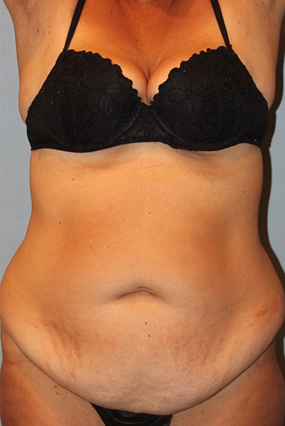 before liposuction female front view case 791