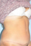 after liposuction female right angle case 791