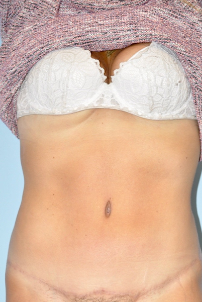 after liposuction female front view case 791