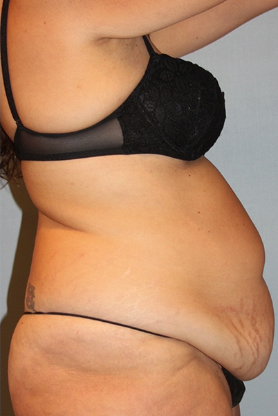 before liposuction female side view case 791