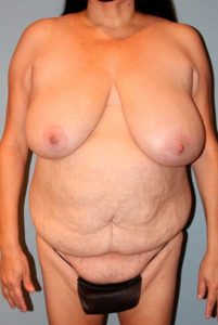 Patient Tummy Tuck Before 0