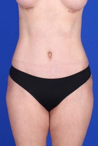 after tummy tuck front view of female patient 451 at Paydar Plastic Surgery